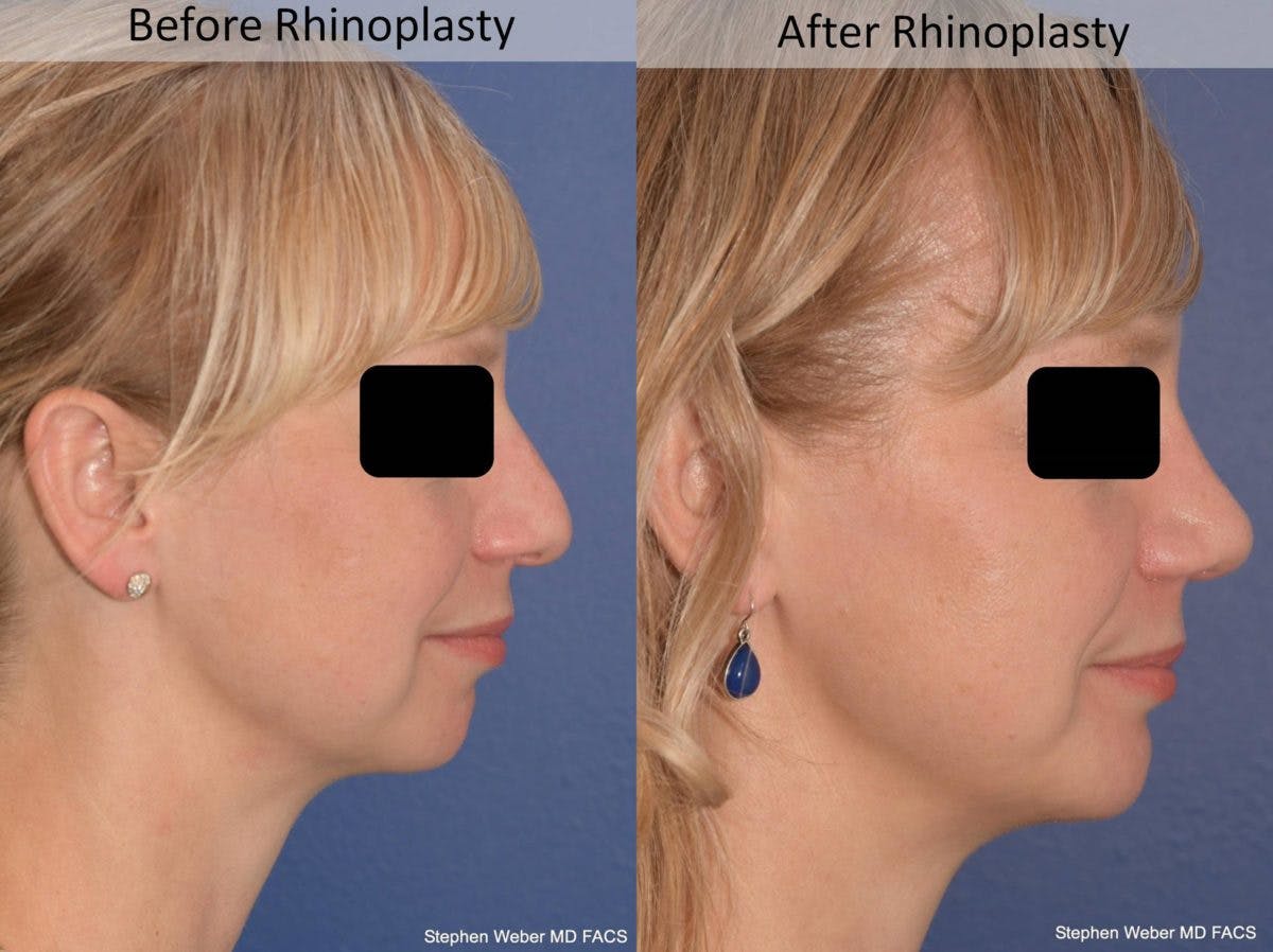 Rhinoplasty Before & After Gallery - Patient 387186 - Image 4