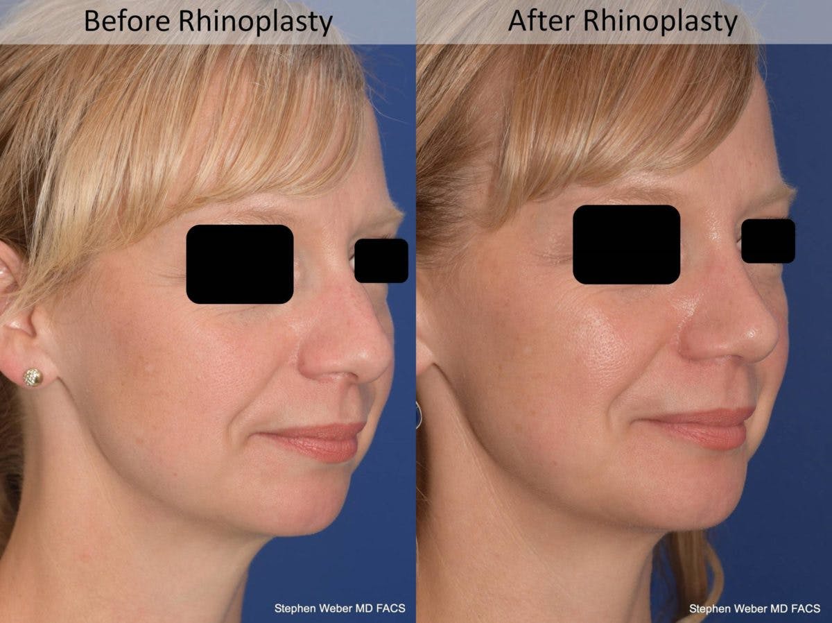 Rhinoplasty Before & After Gallery - Patient 387186 - Image 5