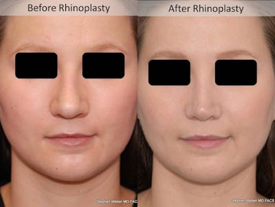 Rhinoplasty Before & After Gallery - Patient 194779 - Image 1