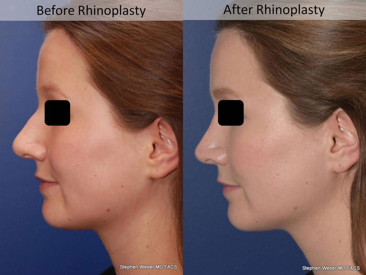 Rhinoplasty Before & After Gallery - Patient 194779 - Image 2