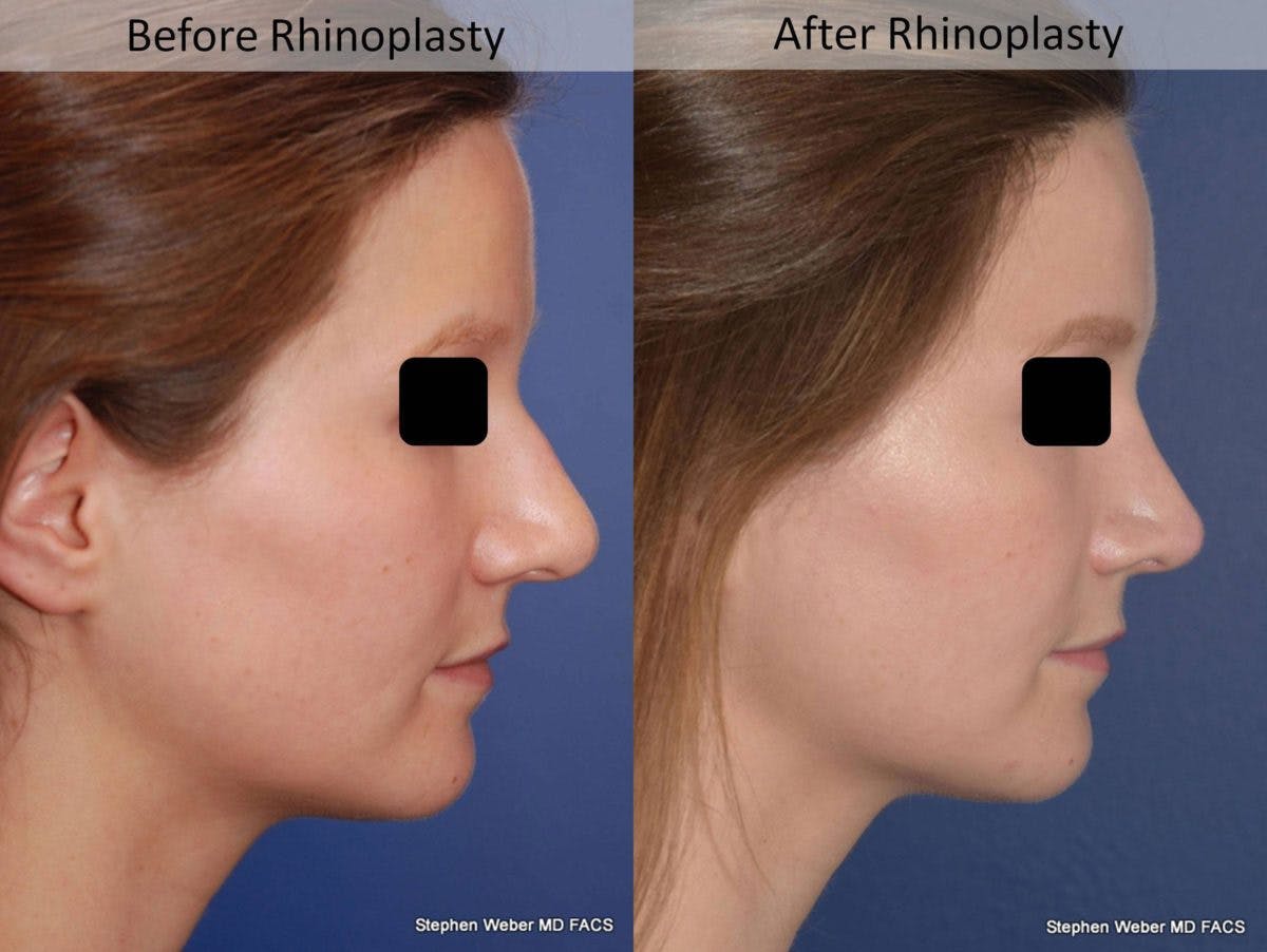 Rhinoplasty Before & After Gallery - Patient 194779 - Image 3
