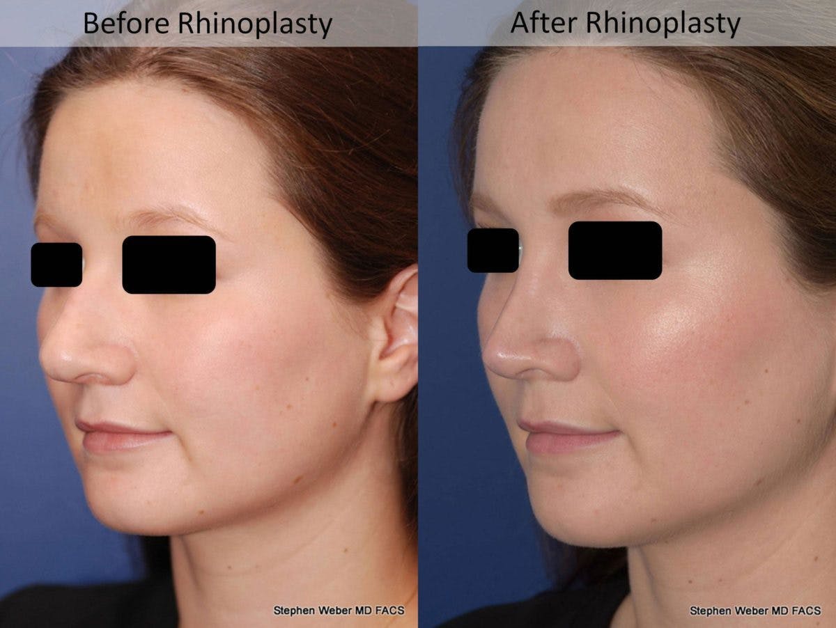 Rhinoplasty Before & After Gallery - Patient 194779 - Image 4