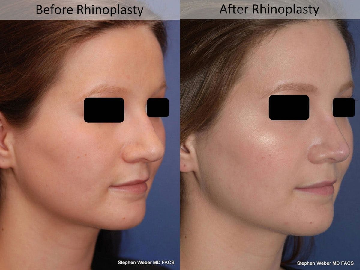 Rhinoplasty Before & After Gallery - Patient 194779 - Image 5
