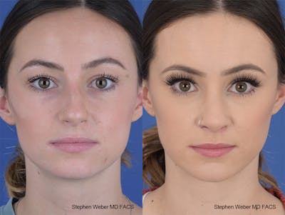 Rhinoplasty Before & After Gallery - Patient 251367 - Image 1
