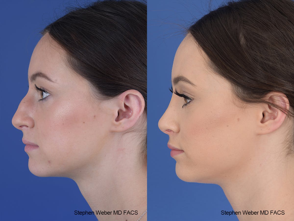 Rhinoplasty Before & After Gallery - Patient 251367 - Image 2
