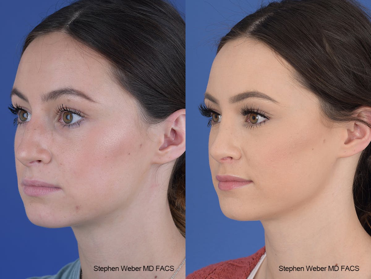 Rhinoplasty Before & After Gallery - Patient 251367 - Image 3
