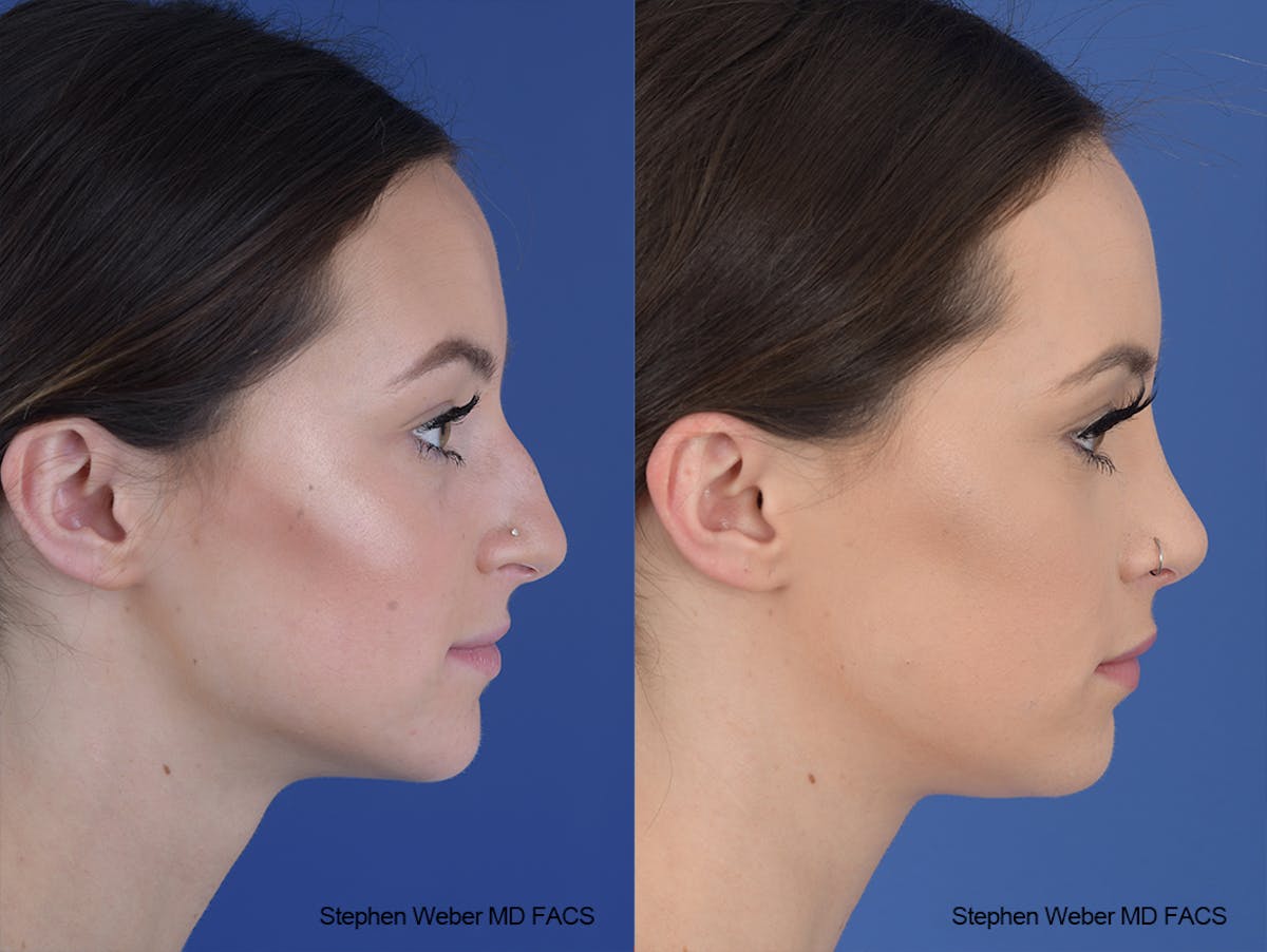 Rhinoplasty Before & After Gallery - Patient 251367 - Image 4