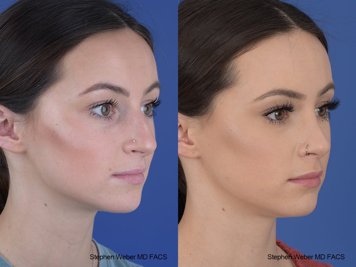 Rhinoplasty Before & After Gallery - Patient 251367 - Image 5