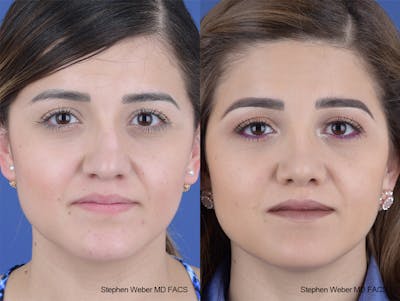 Rhinoplasty Before & After Gallery - Patient 313578 - Image 1