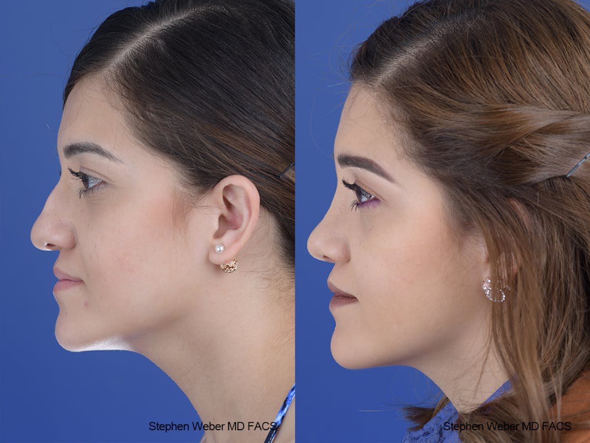 Rhinoplasty Before & After Gallery - Patient 313578 - Image 2