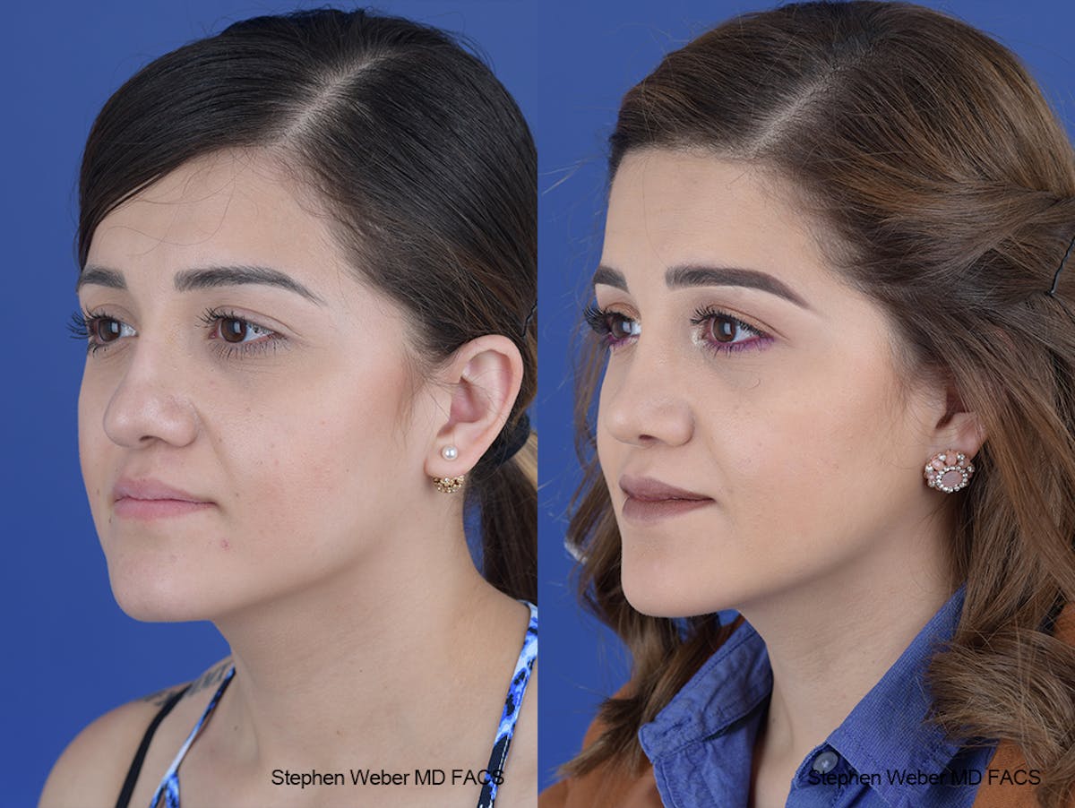 Rhinoplasty Before & After Gallery - Patient 313578 - Image 3