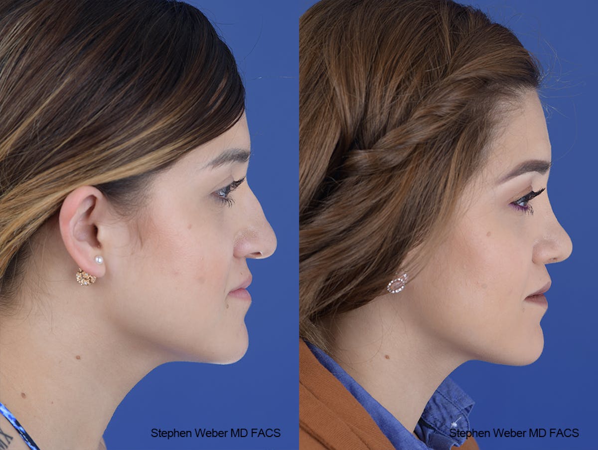 Rhinoplasty Before & After Gallery - Patient 313578 - Image 4