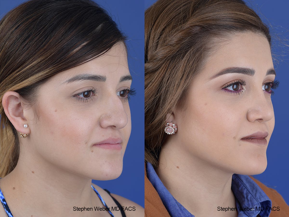 Rhinoplasty Before & After Gallery - Patient 313578 - Image 5