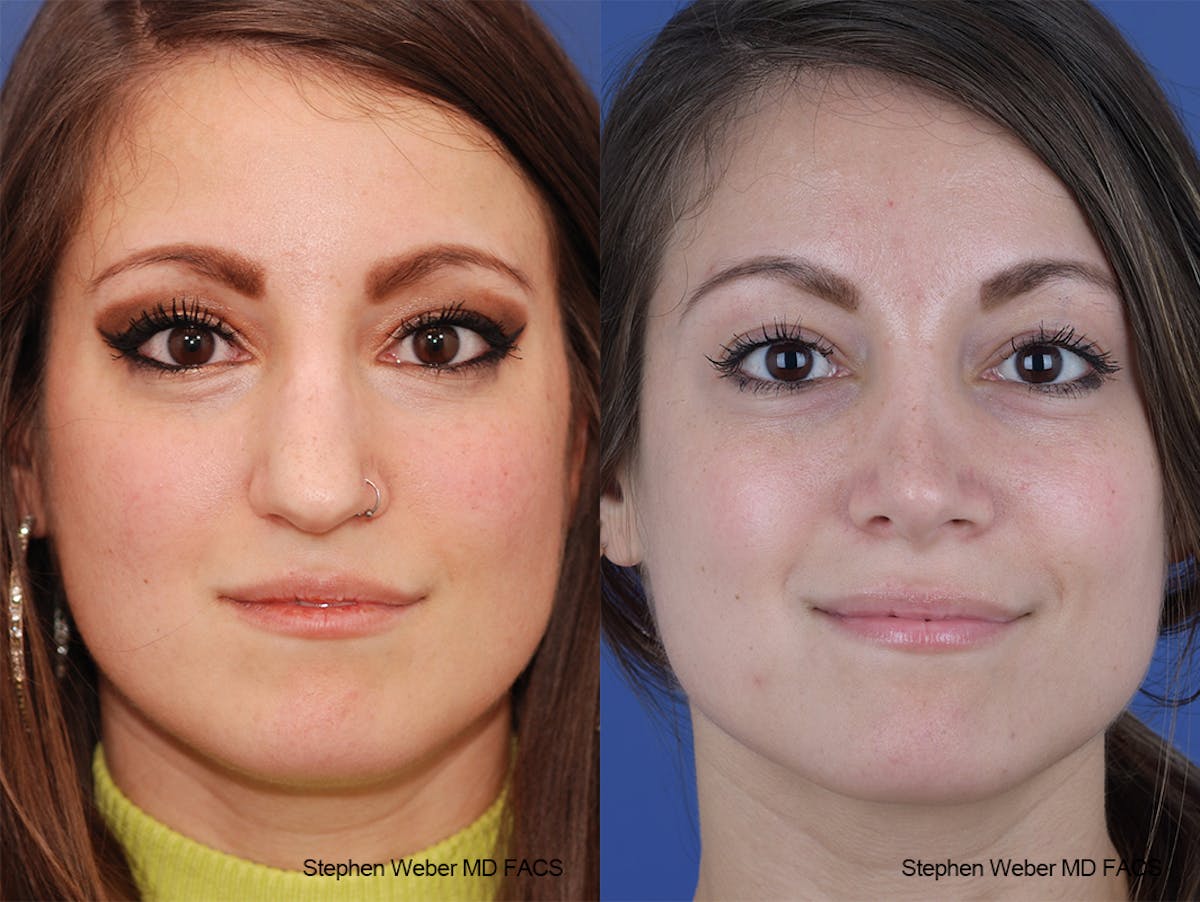 Rhinoplasty Before & After Gallery - Patient 411969 - Image 1