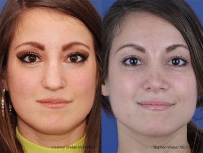 Rhinoplasty Before & After Gallery - Patient 411969 - Image 1