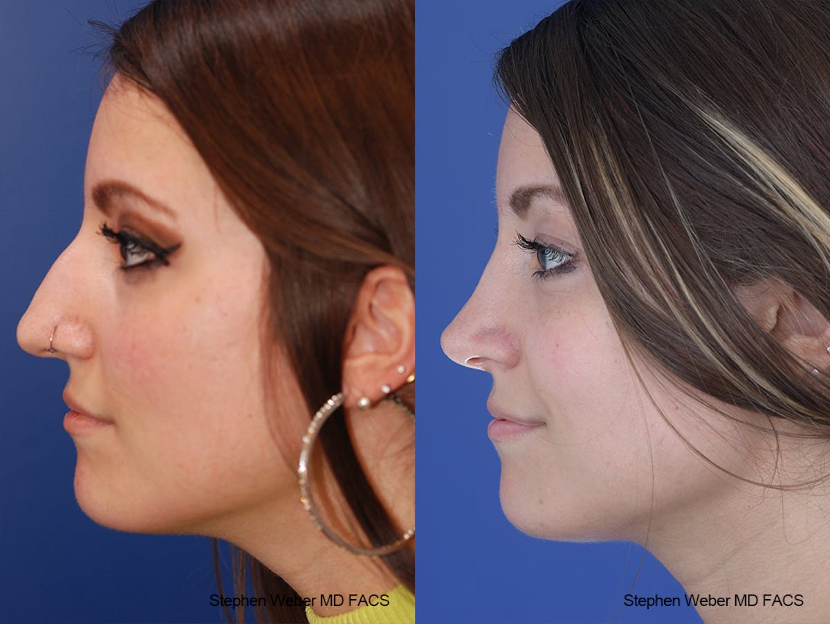 Rhinoplasty Before & After Gallery - Patient 411969 - Image 2