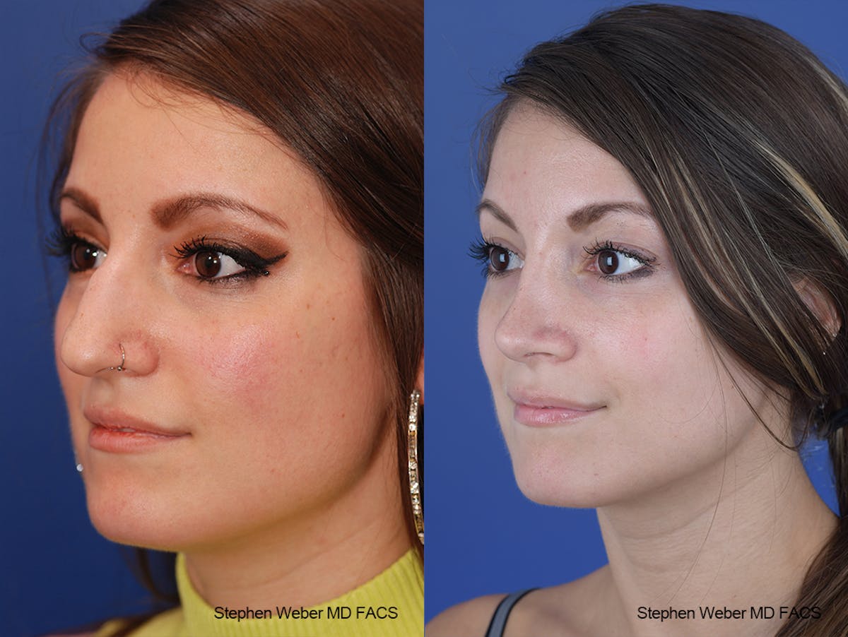 Rhinoplasty Before & After Gallery - Patient 411969 - Image 3