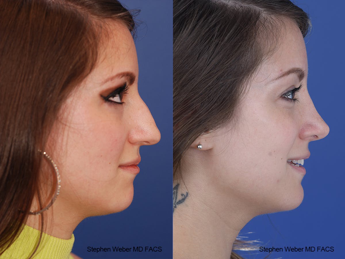 Rhinoplasty Before & After Gallery - Patient 411969 - Image 4