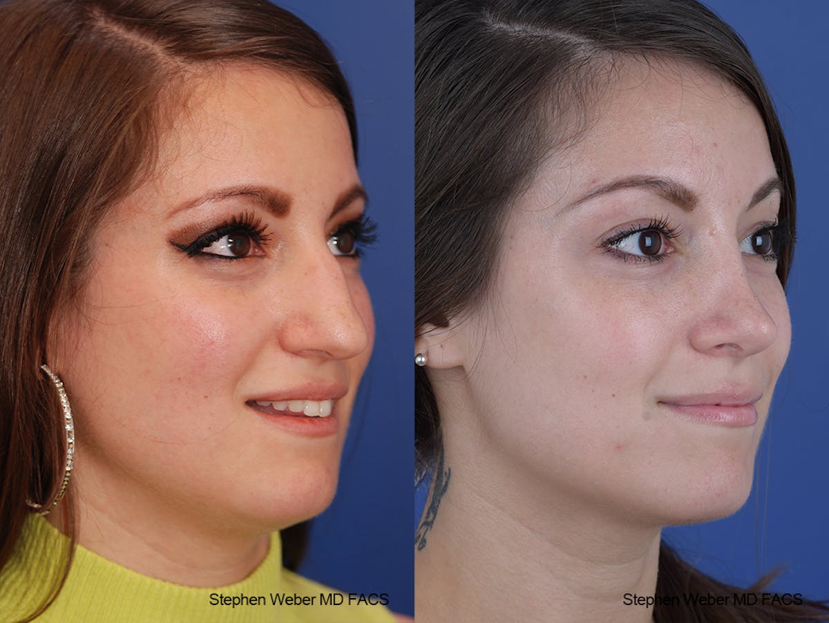 Rhinoplasty Before & After Gallery - Patient 411969 - Image 5