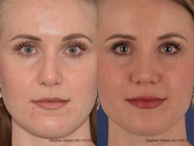 Rhinoplasty Before & After Gallery - Patient 401557 - Image 1