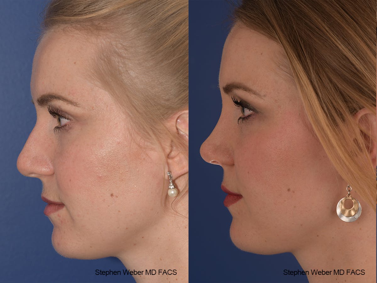 Rhinoplasty Before & After Gallery - Patient 401557 - Image 2