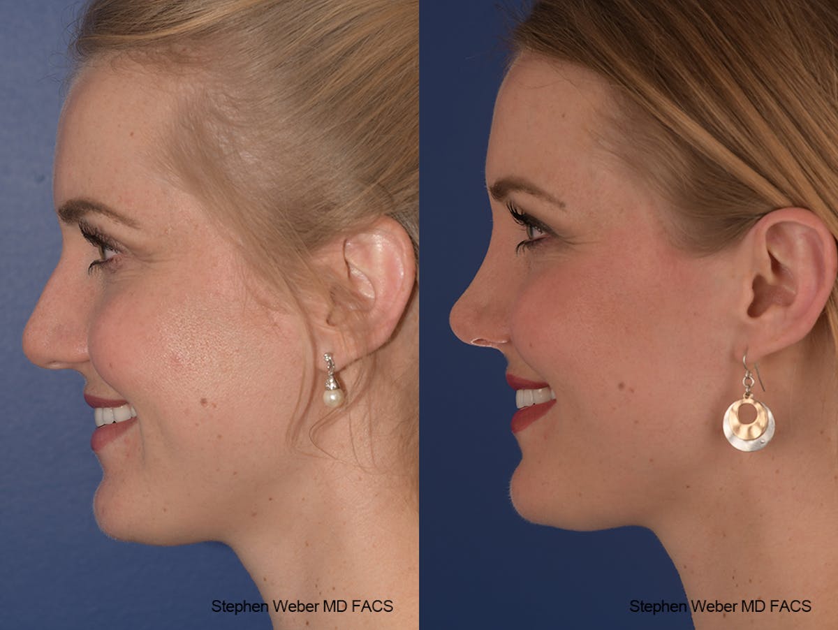 Rhinoplasty Before & After Gallery - Patient 401557 - Image 3