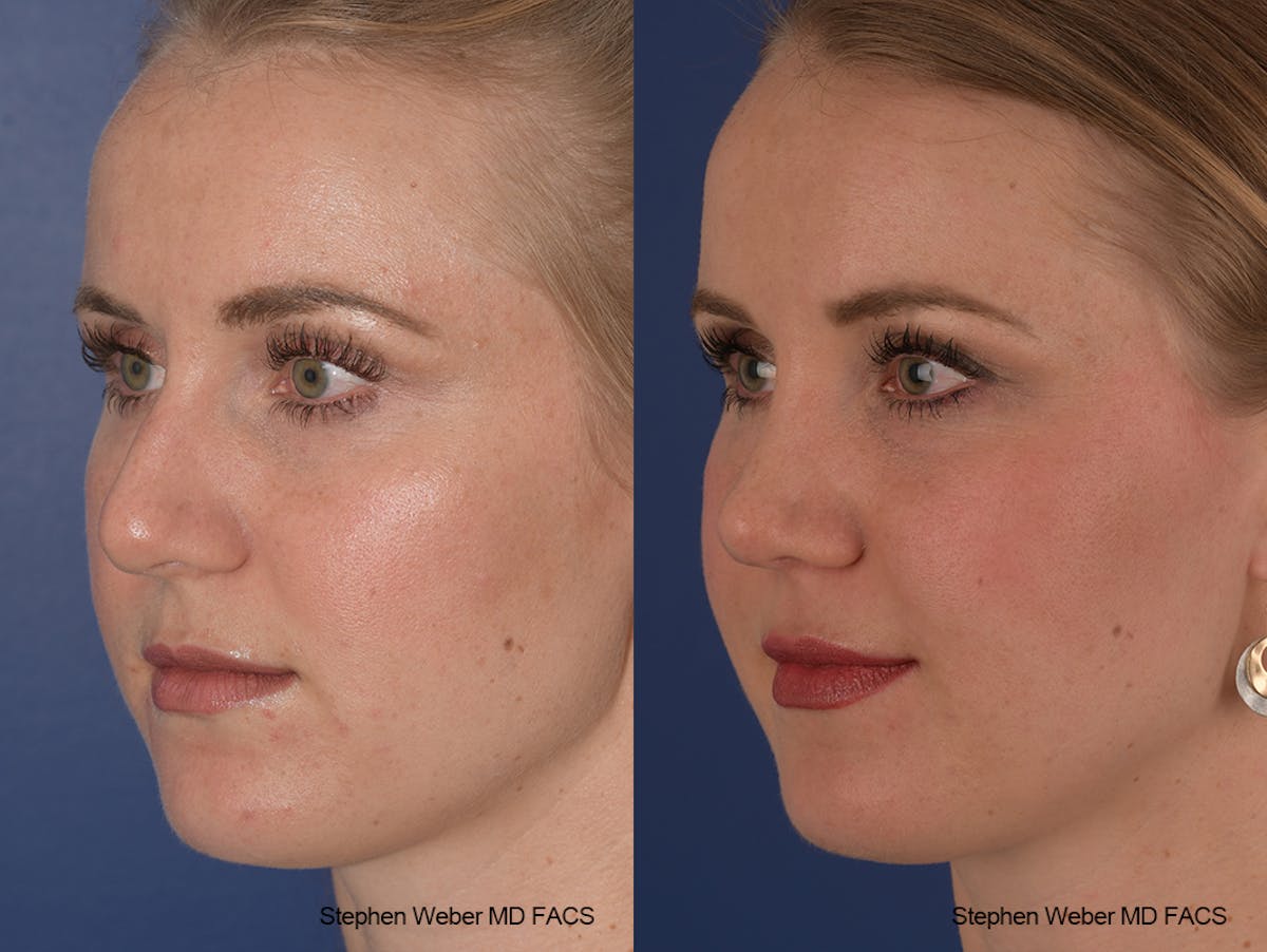 Rhinoplasty Before & After Gallery - Patient 401557 - Image 4