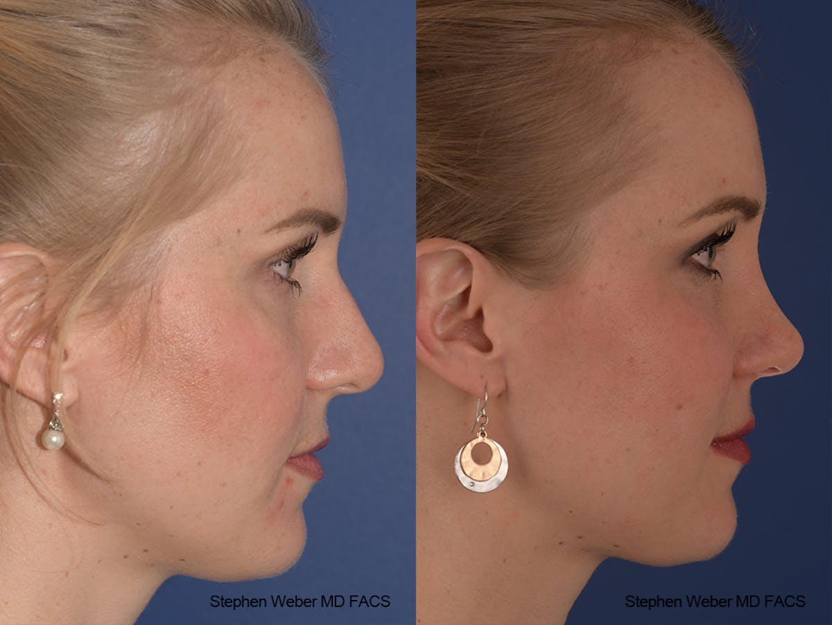 Rhinoplasty Before & After Gallery - Patient 401557 - Image 5