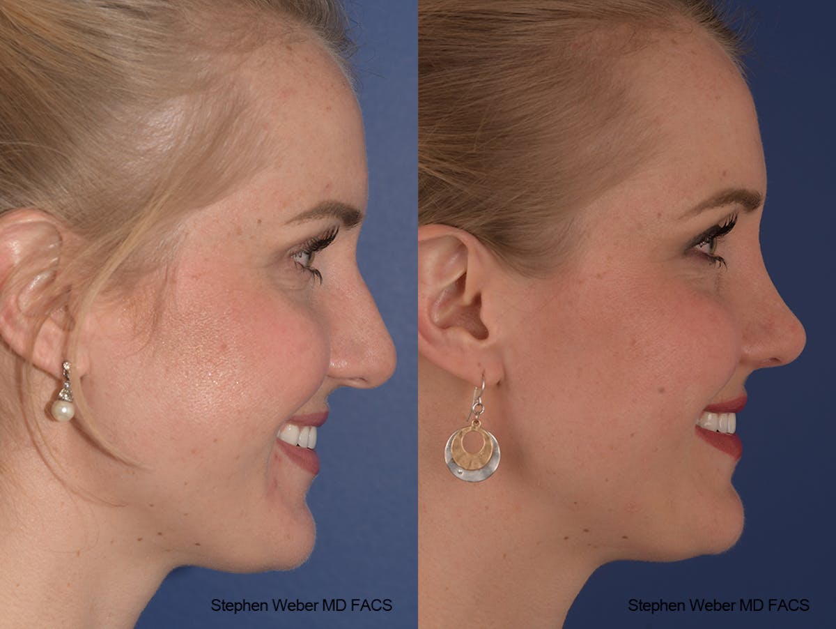 Rhinoplasty Before & After Gallery - Patient 401557 - Image 6