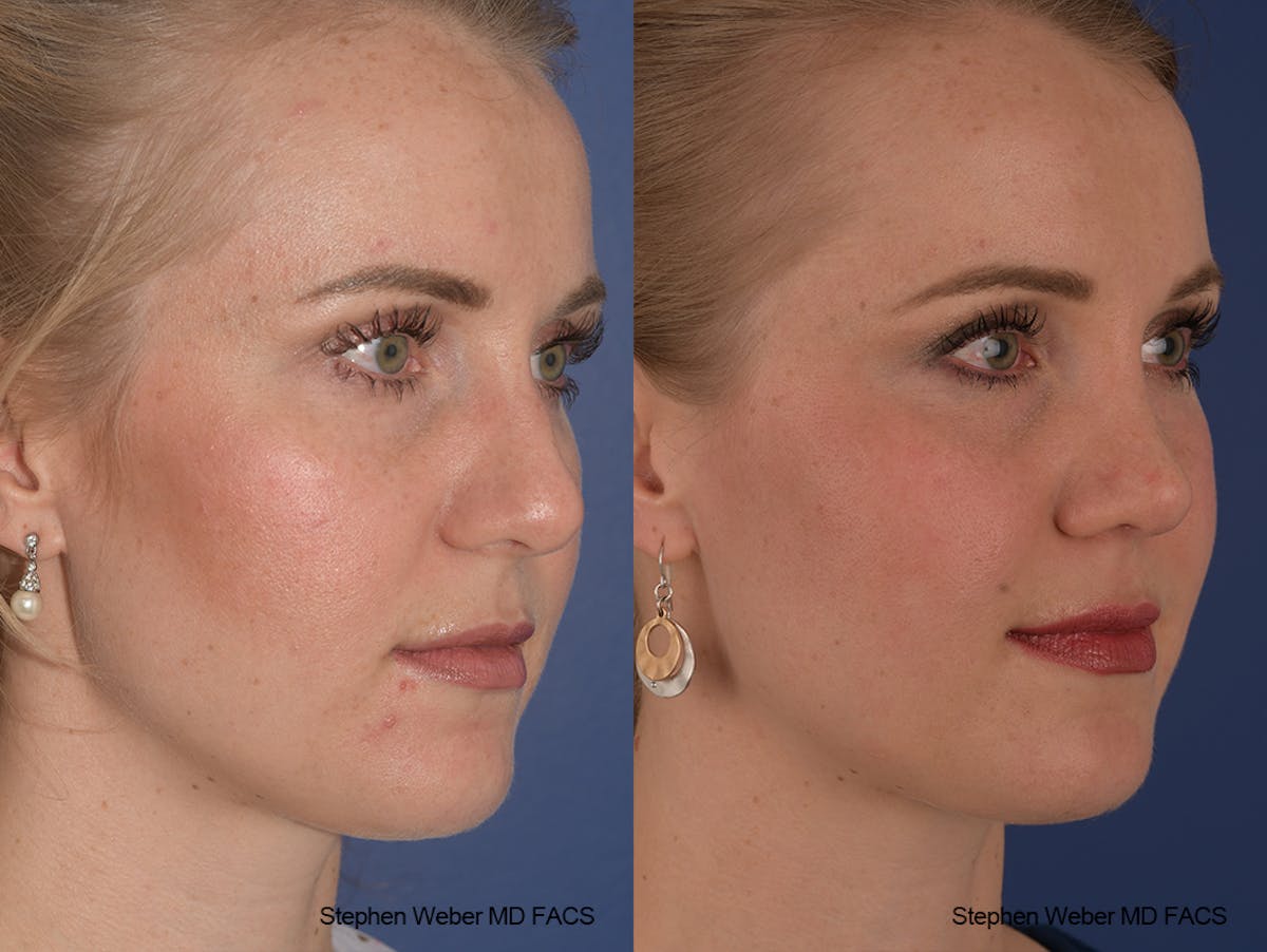 Rhinoplasty Before & After Gallery - Patient 401557 - Image 7
