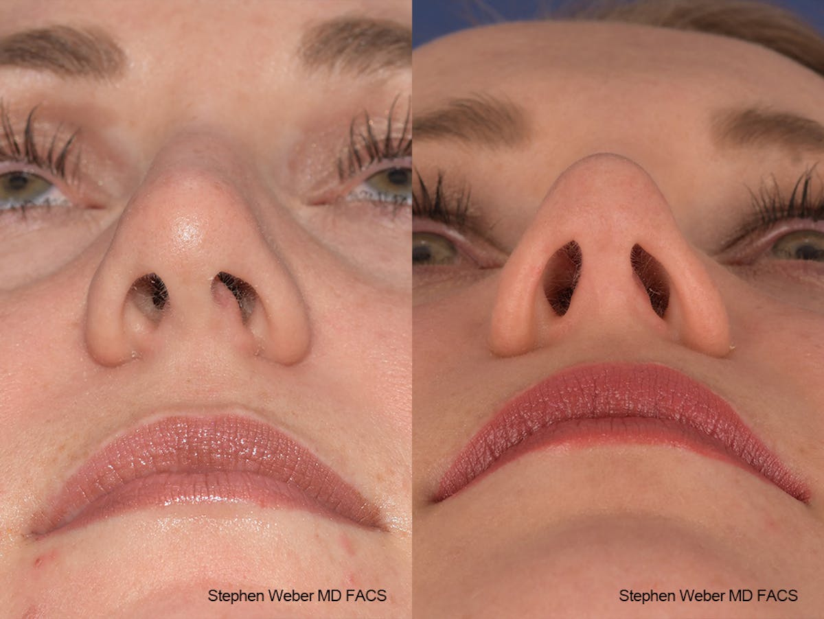 Rhinoplasty Before & After Gallery - Patient 401557 - Image 8