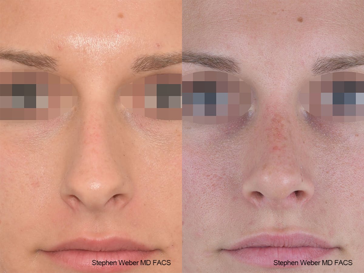 Rhinoplasty Before & After Gallery - Patient 267791 - Image 1