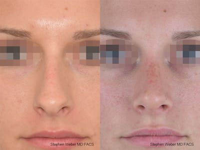 Rhinoplasty Before & After Gallery - Patient 267791 - Image 1