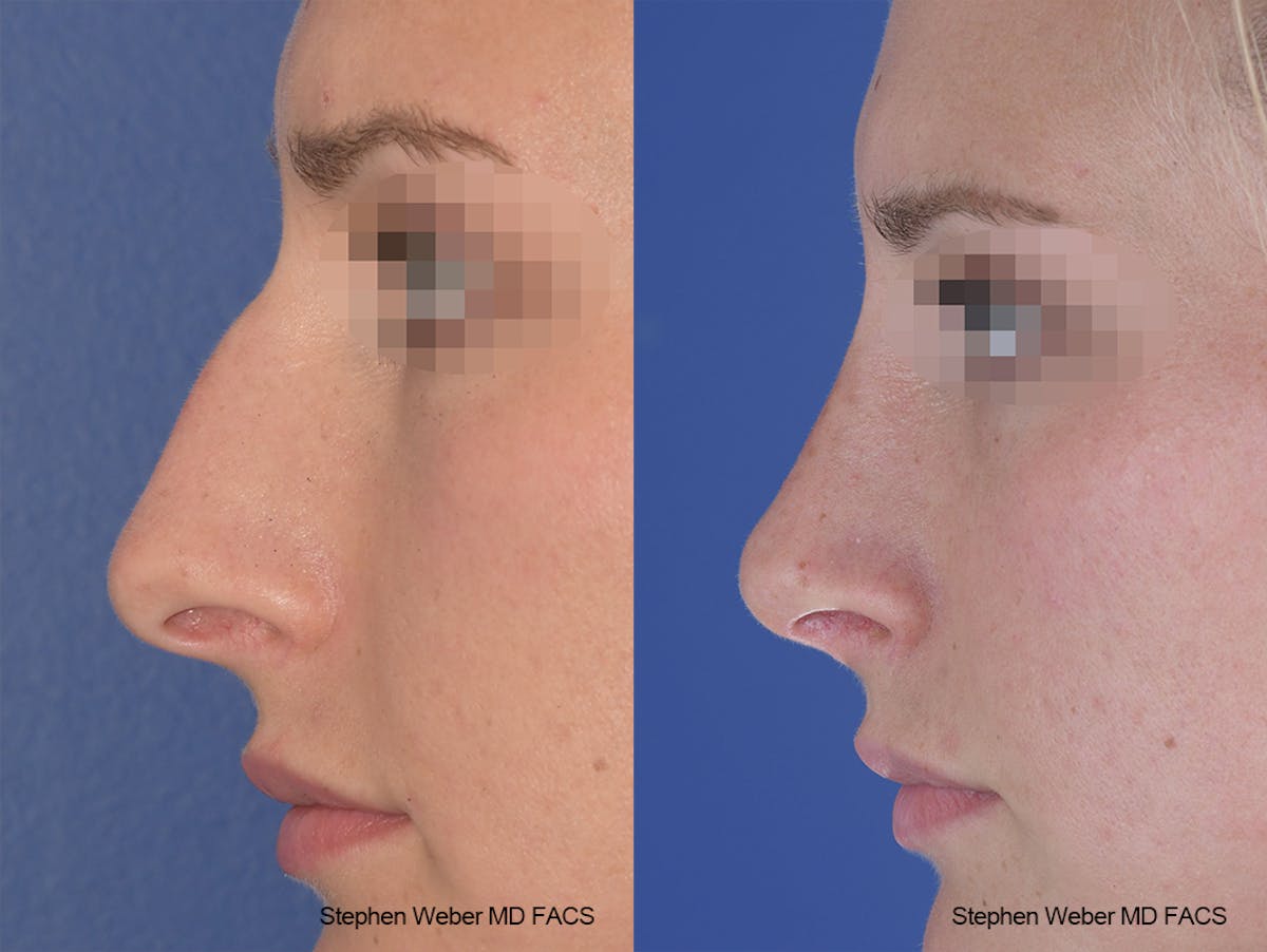 Rhinoplasty Before & After Gallery - Patient 267791 - Image 2