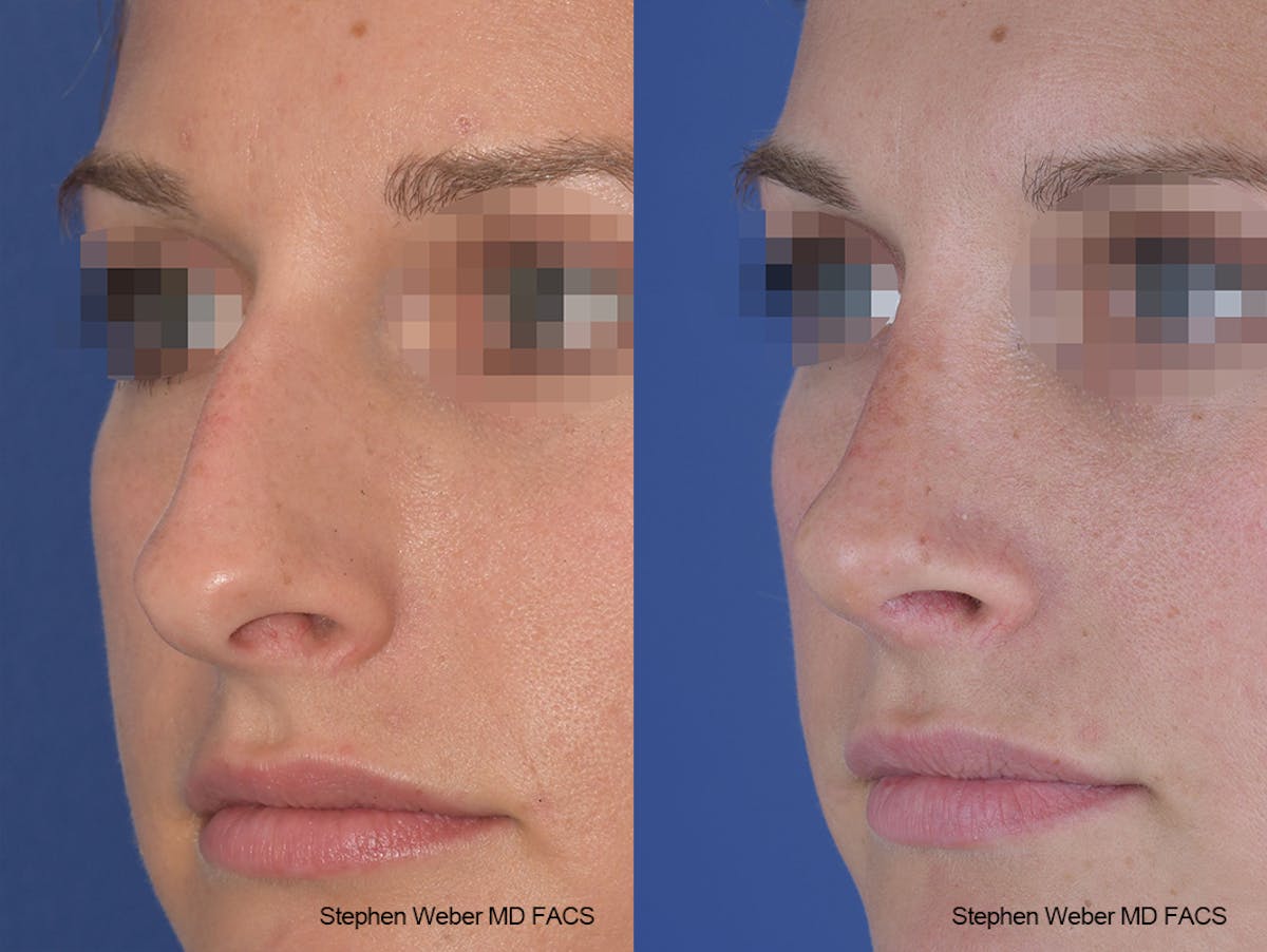 Rhinoplasty Before & After Gallery - Patient 267791 - Image 3