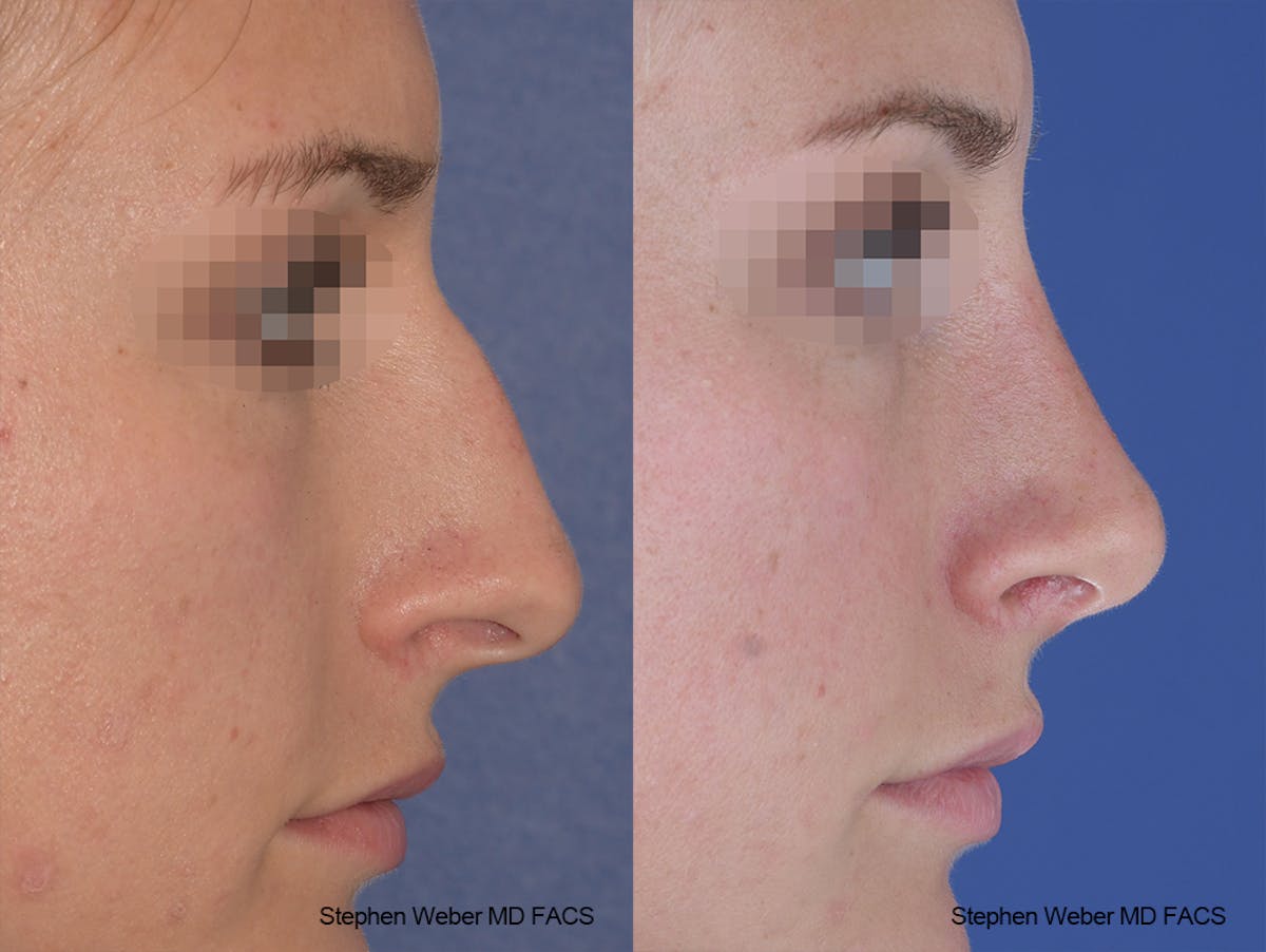 Rhinoplasty Before & After Gallery - Patient 267791 - Image 4