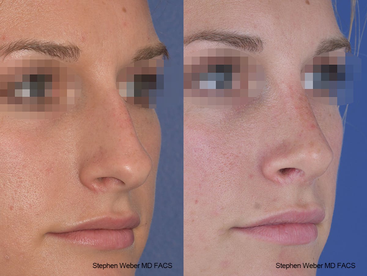 Rhinoplasty Before & After Gallery - Patient 267791 - Image 5