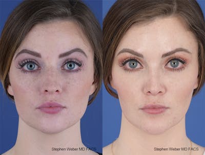 Rhinoplasty Before & After Gallery - Patient 229268 - Image 1