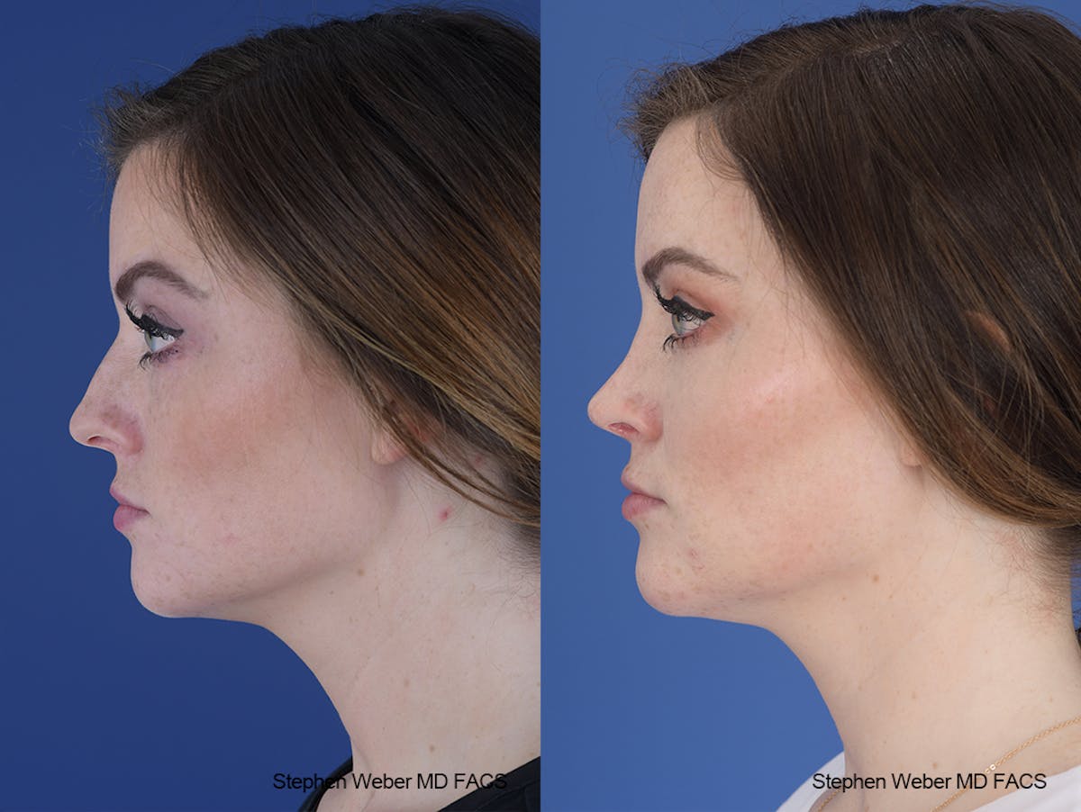 Rhinoplasty Before & After Gallery - Patient 229268 - Image 2
