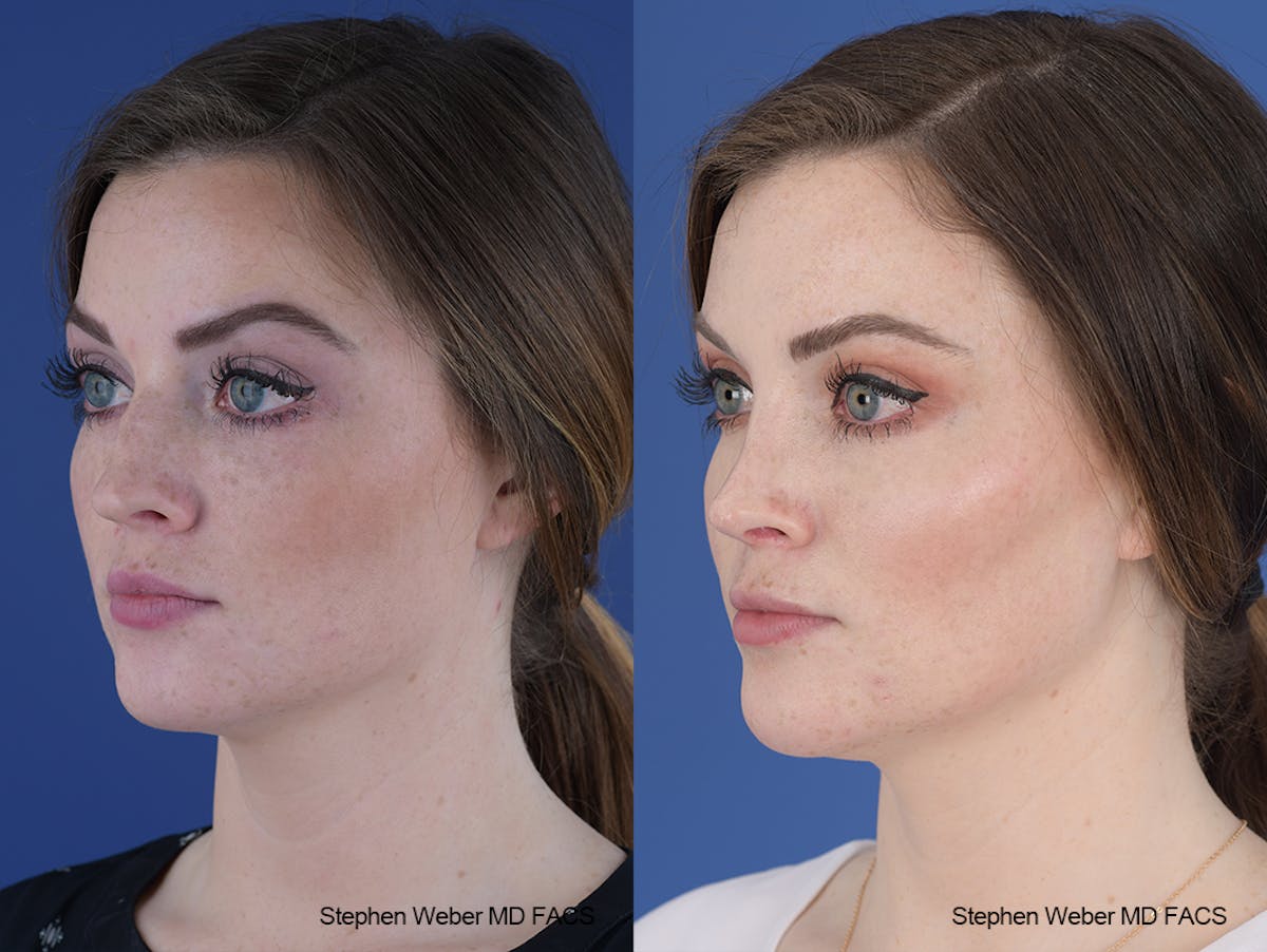Rhinoplasty Before & After Gallery - Patient 229268 - Image 3