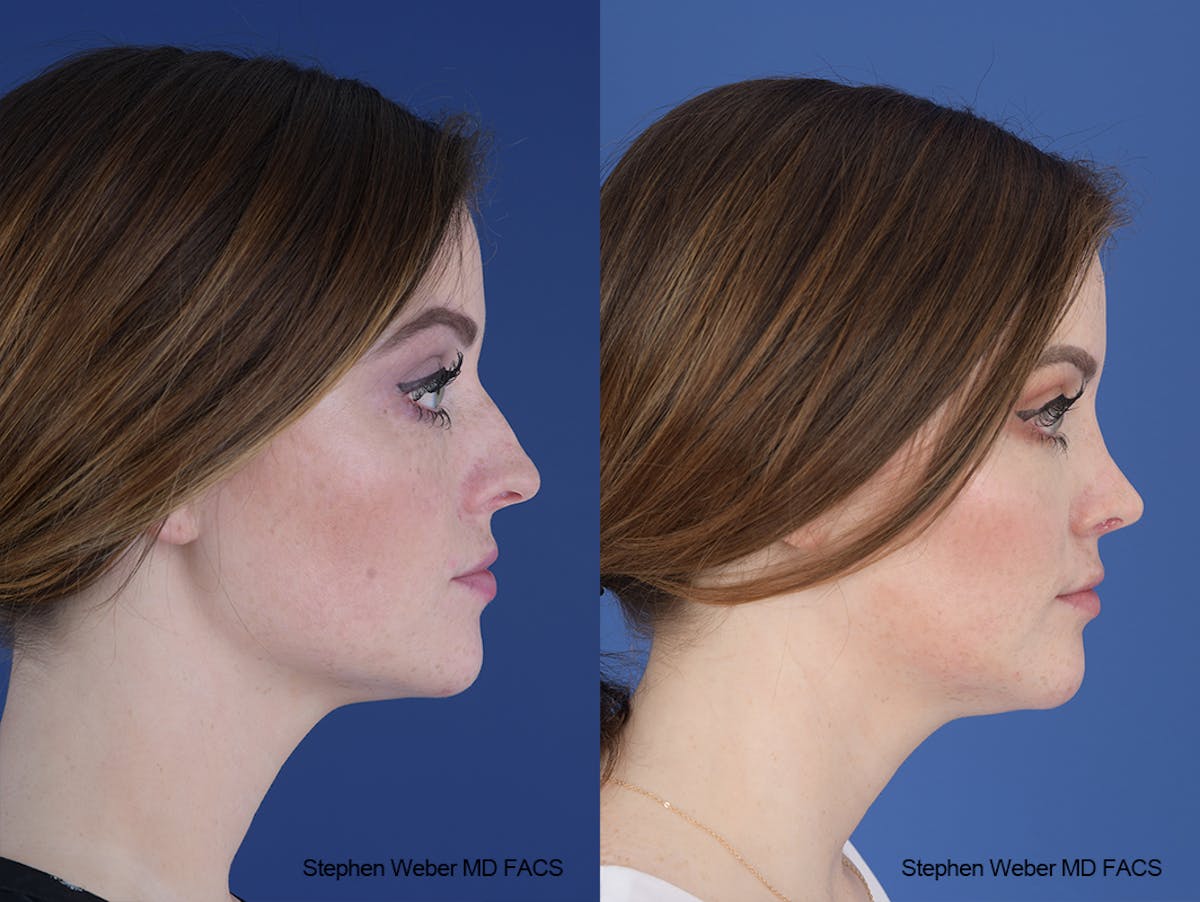 Rhinoplasty Before & After Gallery - Patient 229268 - Image 4