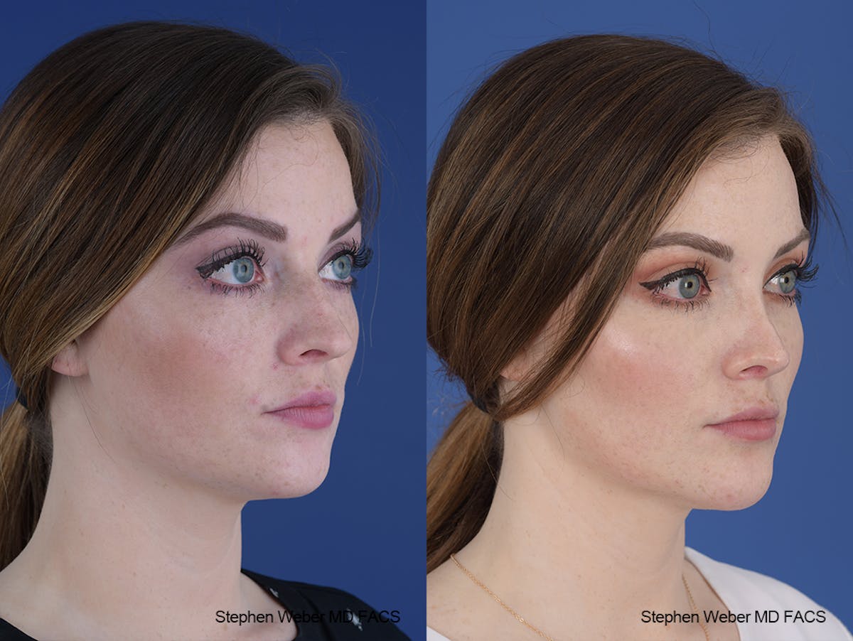 Rhinoplasty Before & After Gallery - Patient 229268 - Image 5
