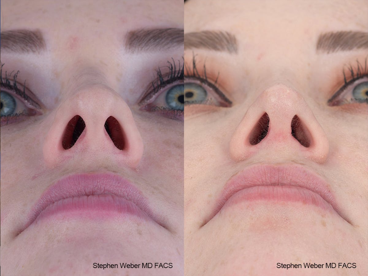 Rhinoplasty Before & After Gallery - Patient 229268 - Image 6