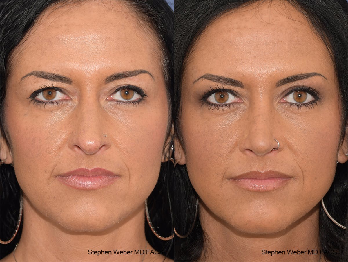 Rhinoplasty Before & After Gallery - Patient 404377 - Image 1