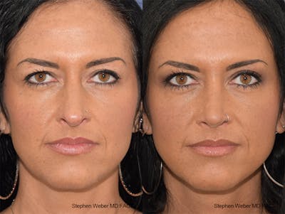 Rhinoplasty Before & After Gallery - Patient 404377 - Image 1
