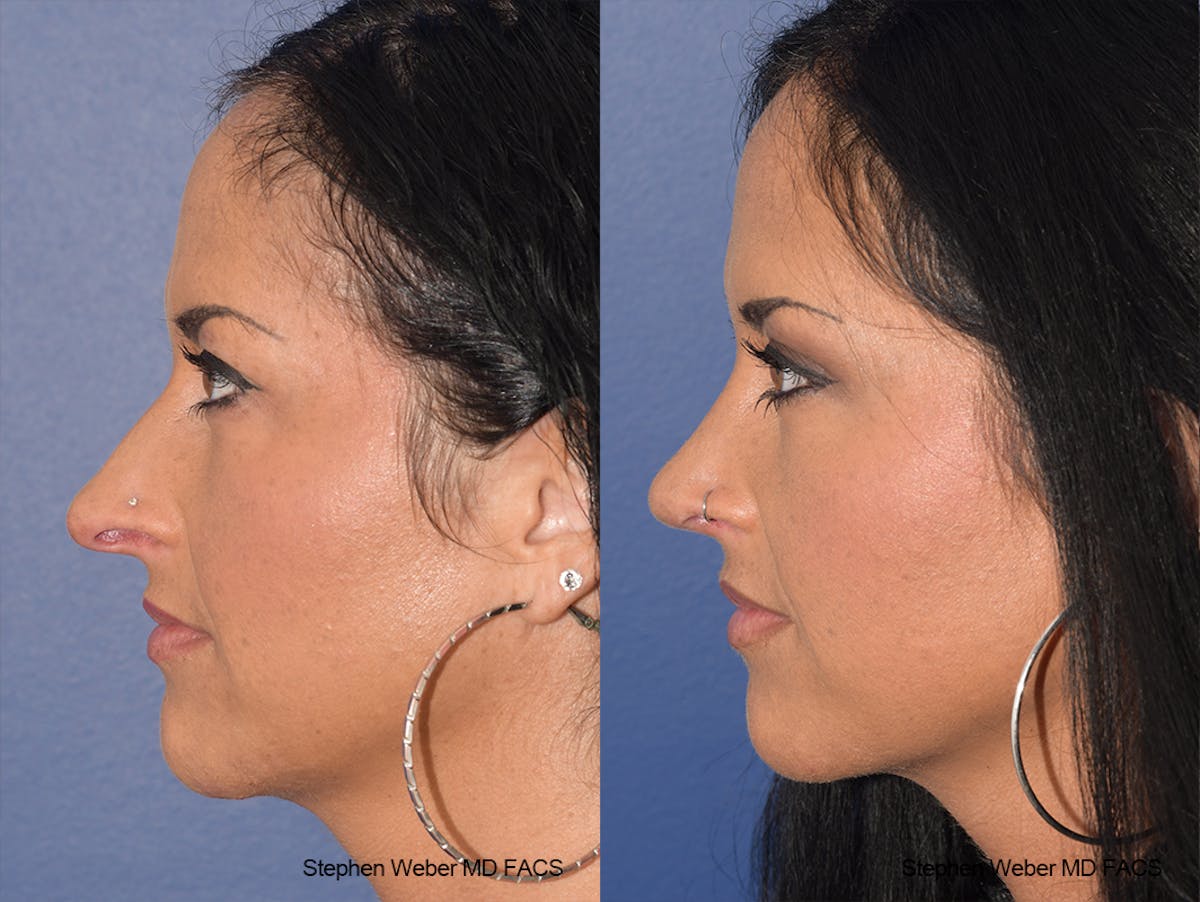 Rhinoplasty Before & After Gallery - Patient 404377 - Image 2
