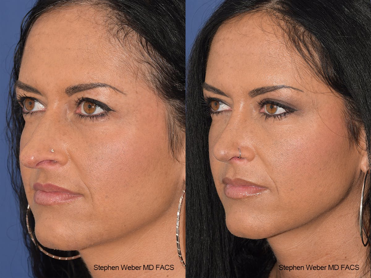 Rhinoplasty Before & After Gallery - Patient 404377 - Image 3