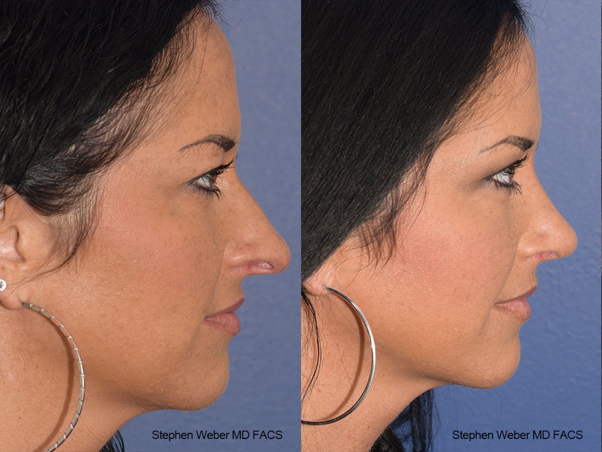 Rhinoplasty Before & After Gallery - Patient 404377 - Image 4