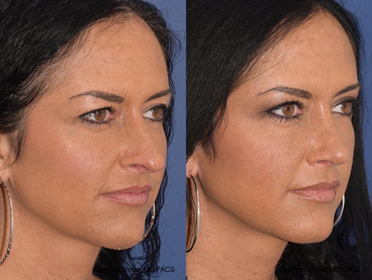 Rhinoplasty Before & After Gallery - Patient 404377 - Image 5