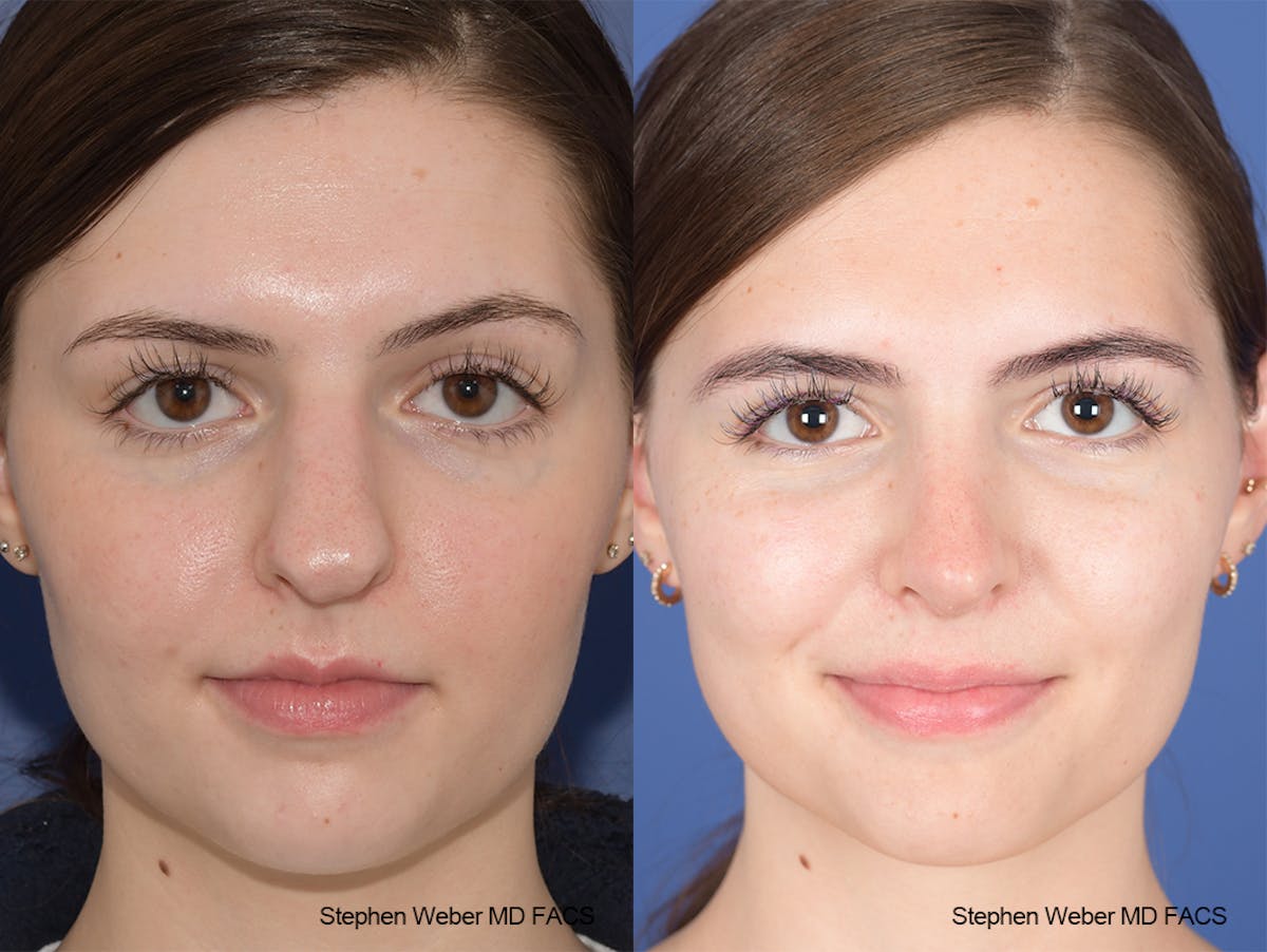 Rhinoplasty Before & After Gallery - Patient 306580 - Image 1